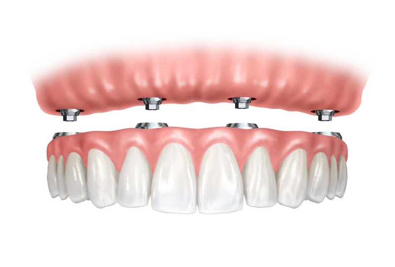 Coronas sobre implantes