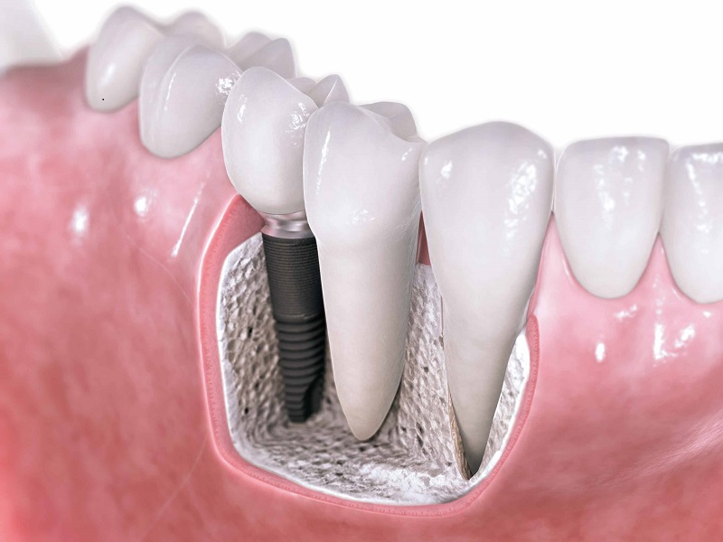 Implante dental