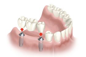 Rehabilitación Oral Mediante Prótesis