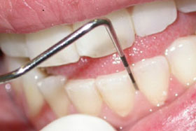 Periodoncia